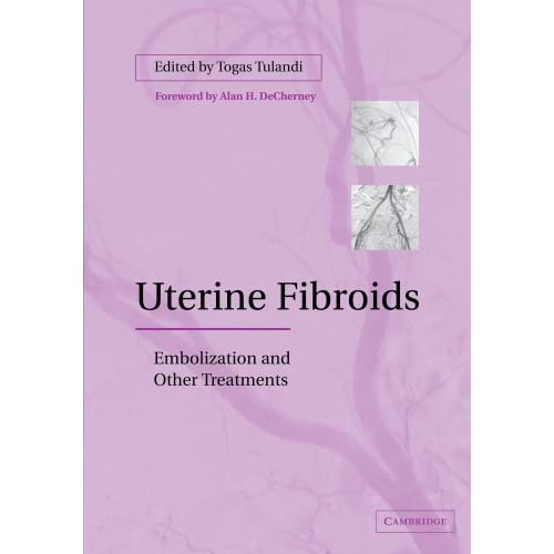 Uterine Fibroids: Embolization and other Treatments