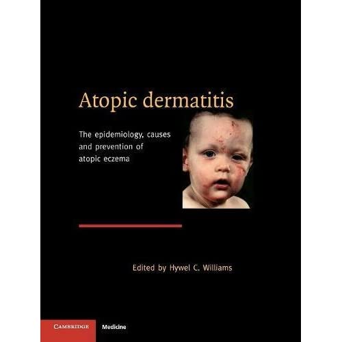 Atopic Dermatitis: The Epidemiology, Causes and Prevention of Atopic Eczema