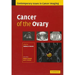 Cancer of the Ovary: 1 (Contemporary Issues in Cancer Imaging)