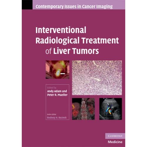 Interventional Radiological Treatment of Liver Tumors (Contemporary Issues in Cancer Imaging)