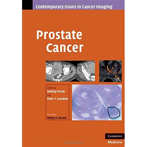 Prostate Cancer (Contemporary Issues in Cancer Imaging)